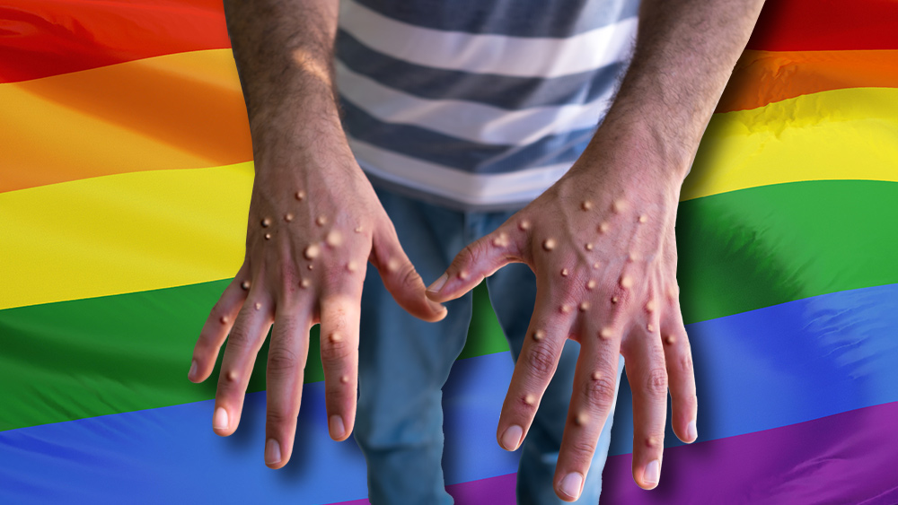 Image: Monkeypox is a gay disease spread by seminal fluid, not merely skin contact, study finds
